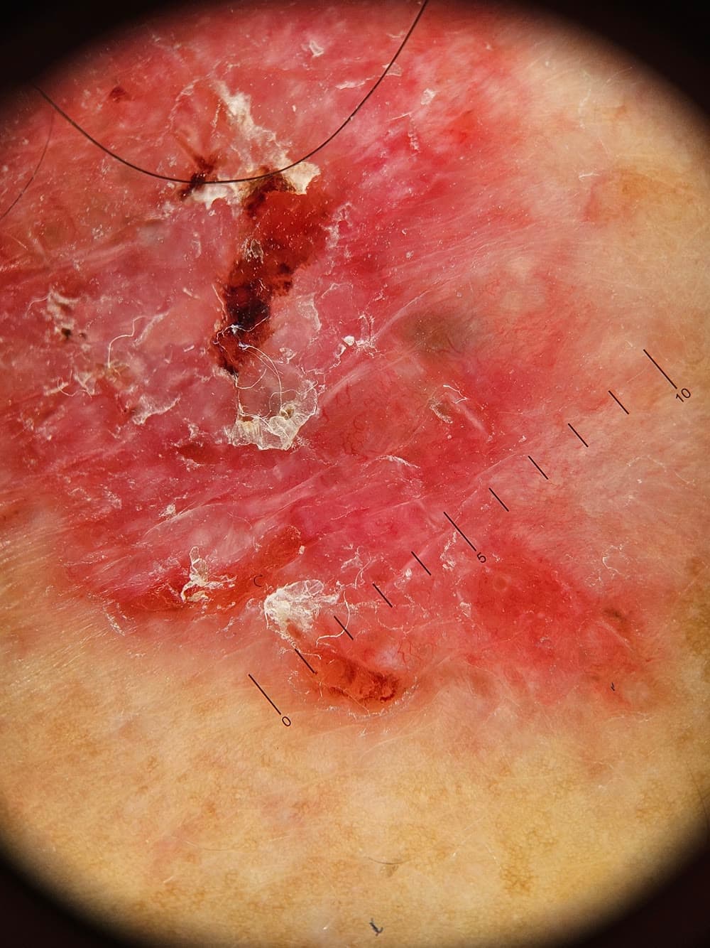 Carcinoma basocelular: o câncer de pele mais comum