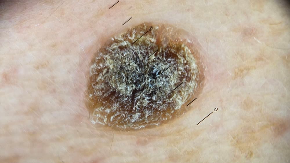Queratose seborreica