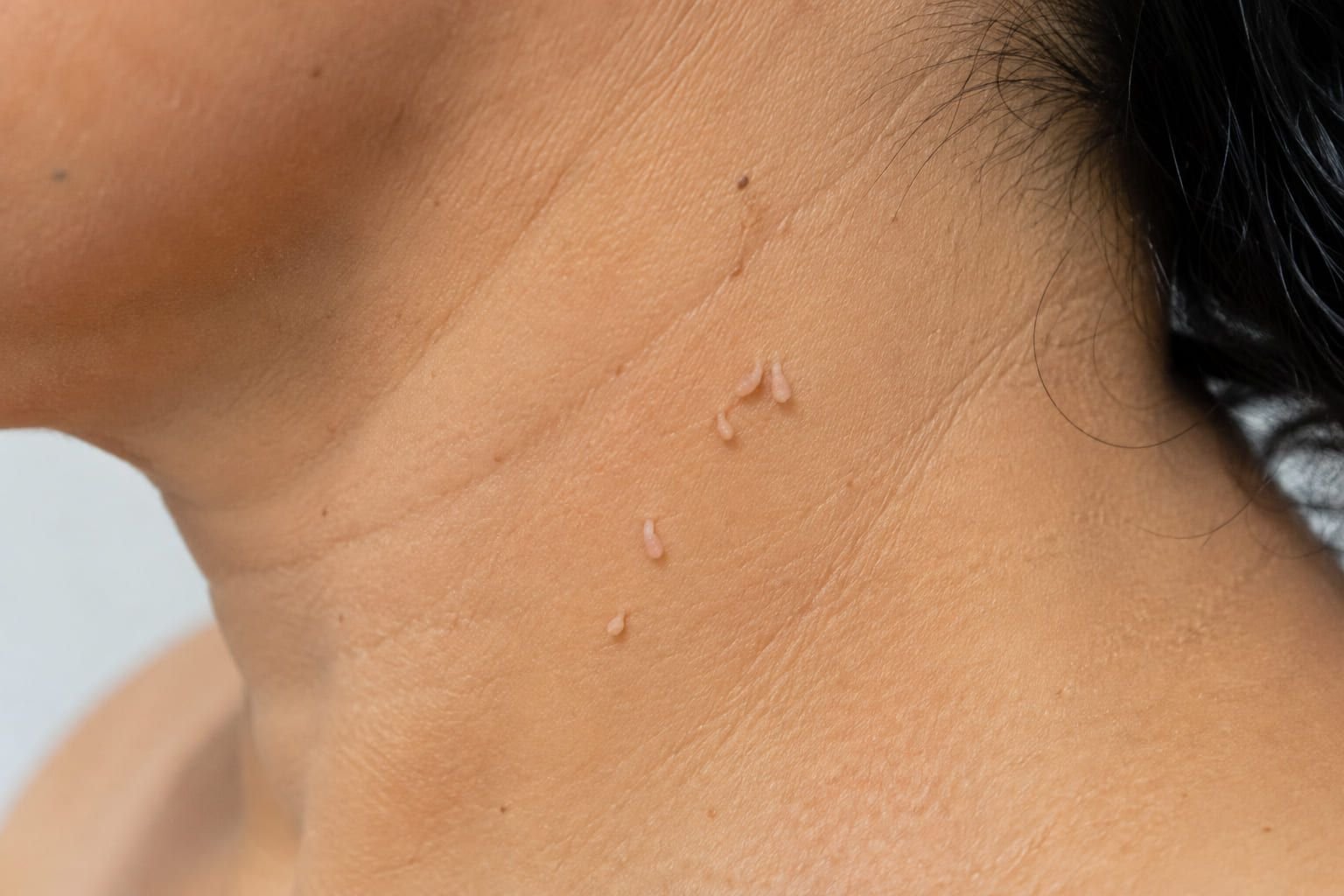 Acrocórdon: aquelas verruguinhas moles no pescoço e nas axilas