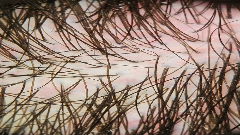 Tricoscopia da área occipital normal com fios uniformemente grossos
