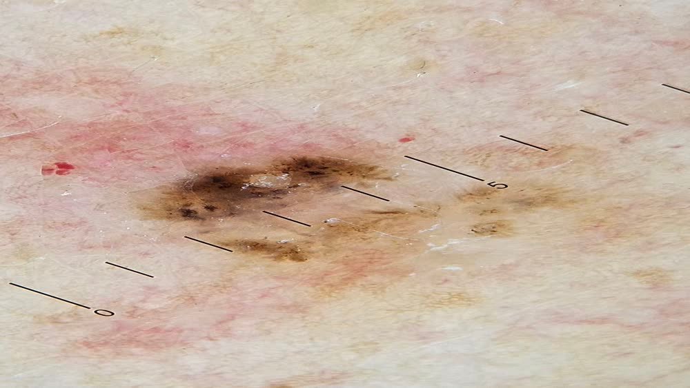 Dermatoscopia de carcinoma basocelular com vasos arboriformes e áreas pigmentadas