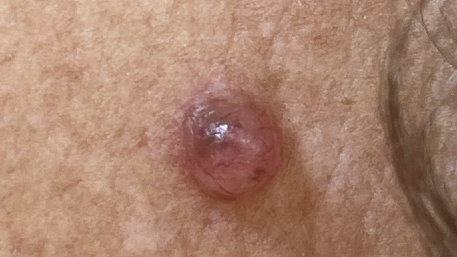 Carcinoma basocelular: os subtipos e por que cada um pede um tratamento diferente