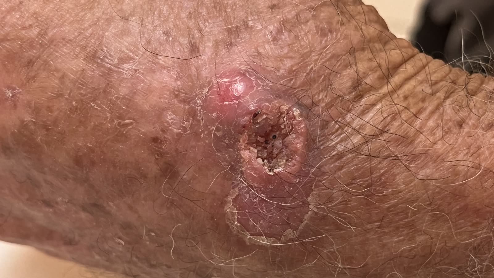 Carcinoma espinocelular: o câncer de pele que exige mais pressa