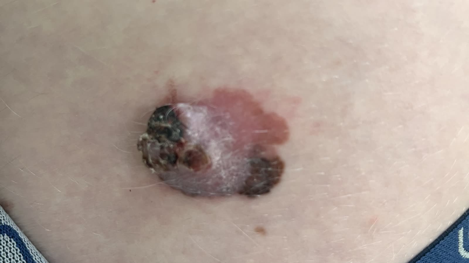 Melanoma: lesão pigmentada assimétrica com múltiplas cores e bordas irregulares