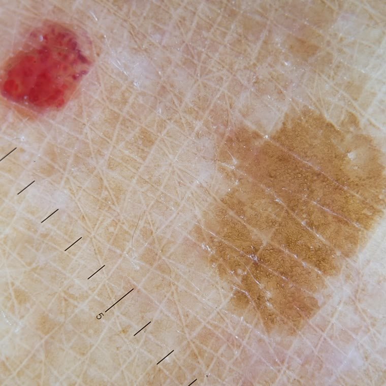 Dermatoscopia: como é o exame de pintas na consulta dermatológica