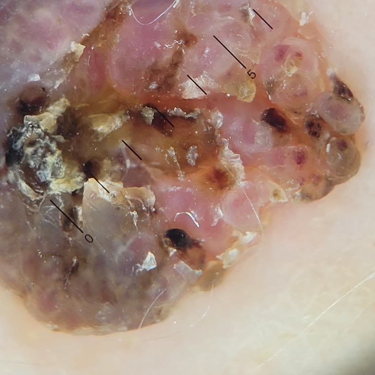 Molusco contagioso: o que é e como tratar