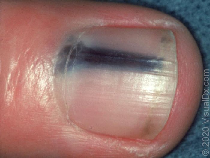 Melanoma na unha: quando a mancha escura merece investigação