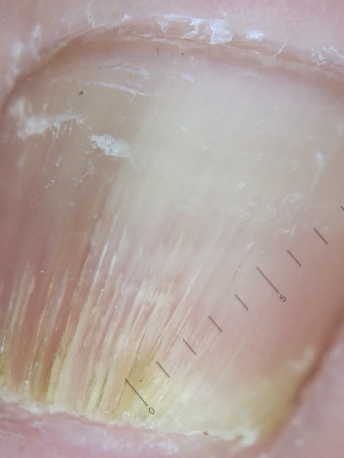 Micose de unha (onicomicose): por que o esmalte não resolve e como é o tratamento