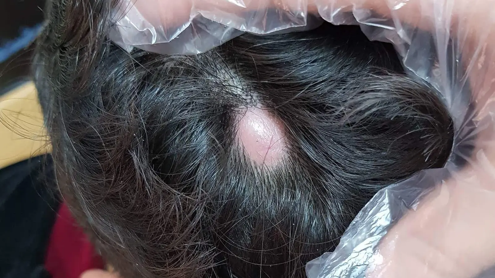 Couro cabeludo visto de cima, com o cabelo afastado por uma mão de luva e um caroço arredondado, liso e rosado, sem fios por cima.