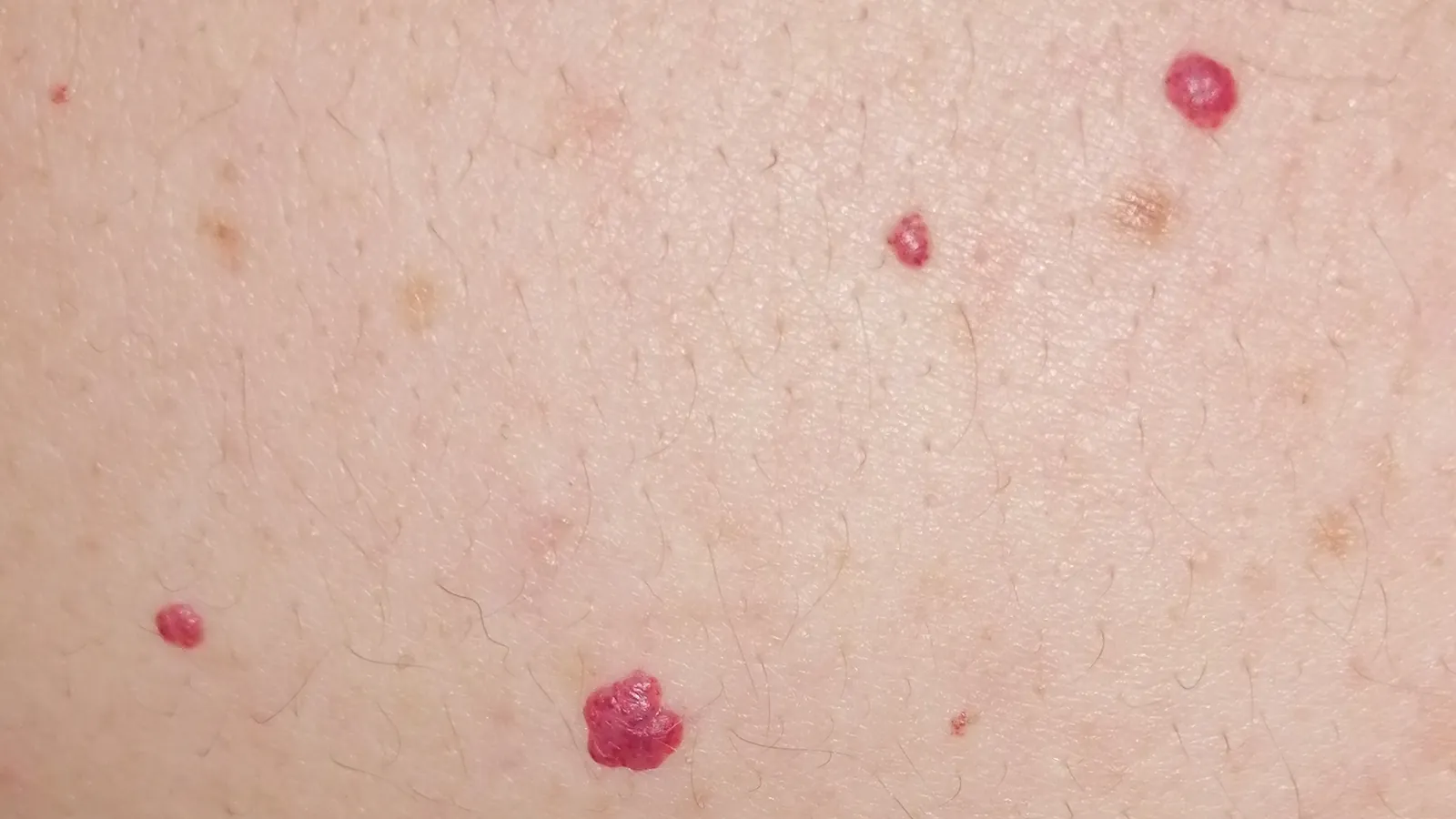 Pele do ombro com quatro pintinhas vermelhas arredondadas, típicas de angioma rubi, e algumas manchas acastanhadas pequenas.