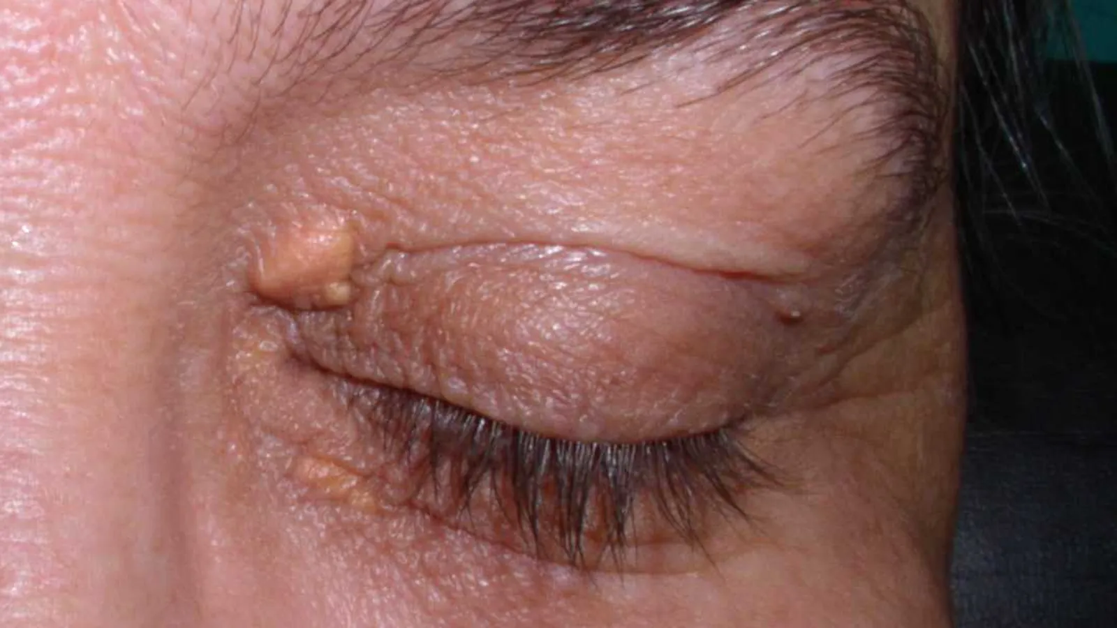 Pálpebra fechada vista de perto, com uma pequena placa amarelada perto do canto interno do olho e outra mais discreta na pálpebra inferior.