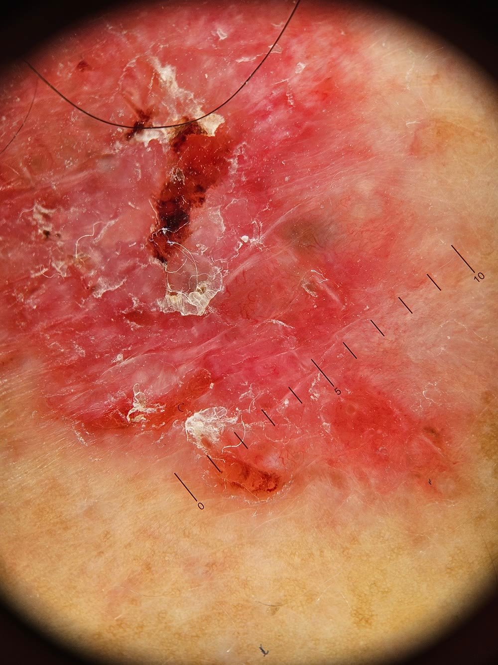 Carcinoma basocelular: o câncer de pele mais comum